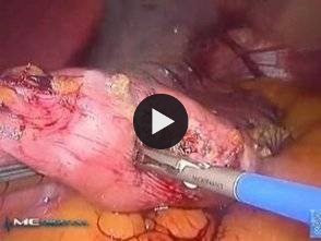 Vidéo: sleeve gastrectomie