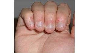 Arrêter de se ronger les ongles